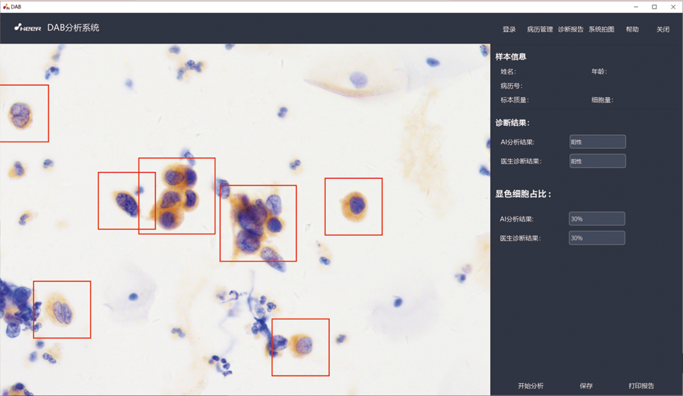HPV E6/E7分析系统